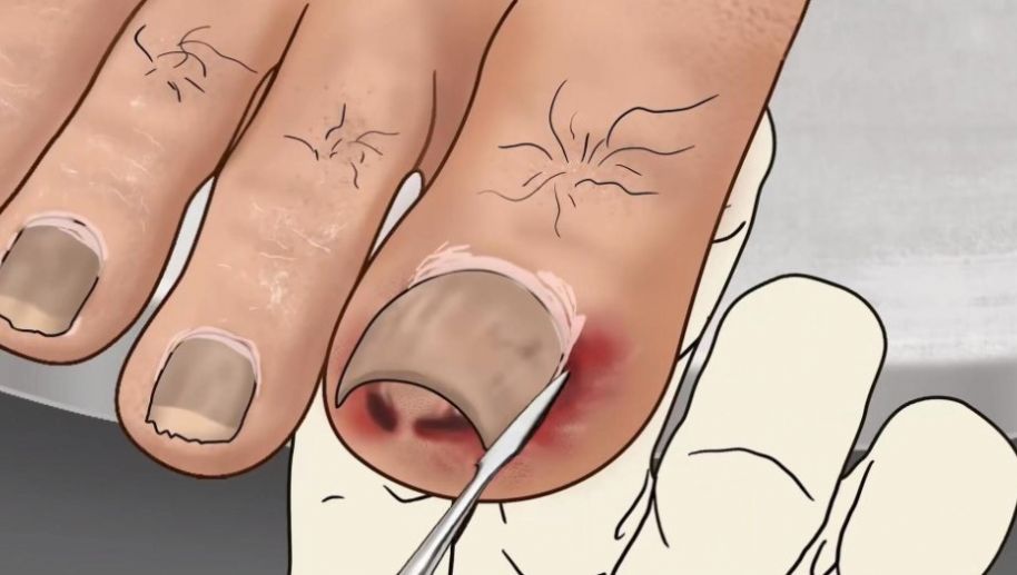 修脚足疔模拟器游戏手机版  v1.0图3